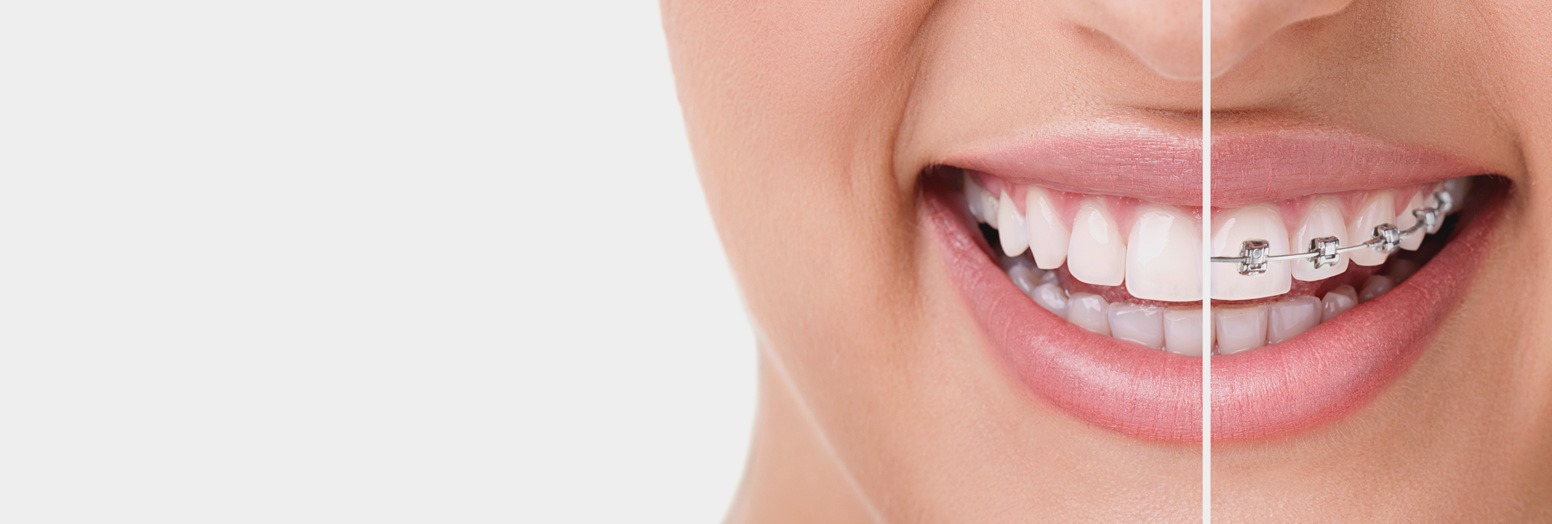 Orthodontie adulte – mieux vaut tard que jamais !